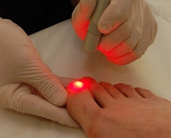Fungal Treatment