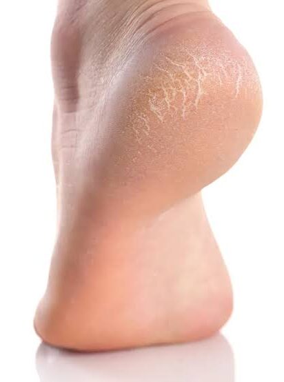 Cracked heels